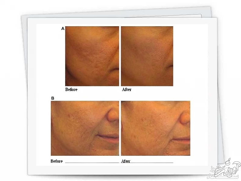 جوانسازی صورت